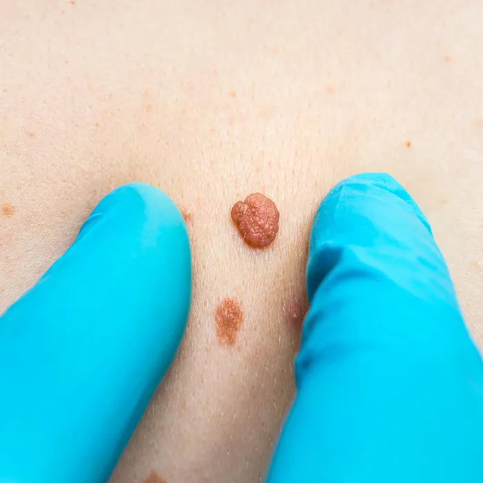 Laser For Birth Marks