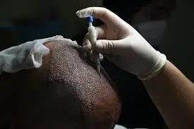 DHI Hair Transplant