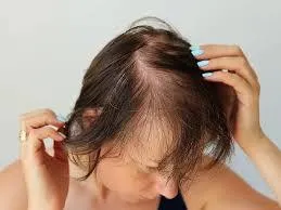 Female Hair Loss