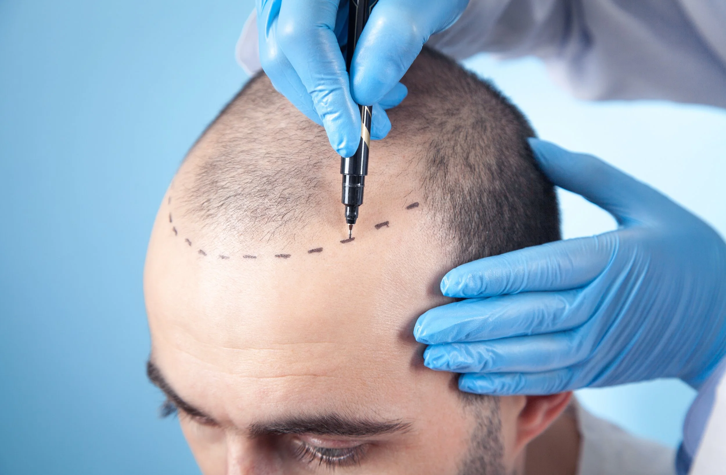 Hair Transplant Clinic Gurgaon