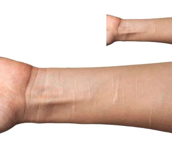 Hesitational Marks Treatment