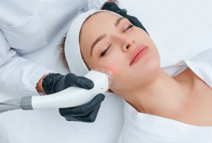 MNRF Radiofrequency Microneedling Treatment