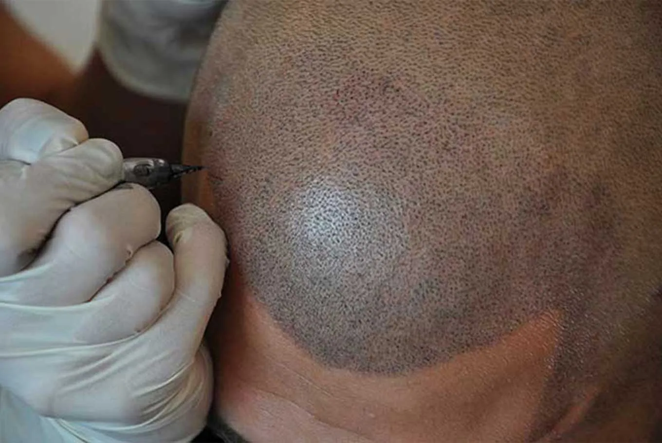 Scalp Micropigmentation