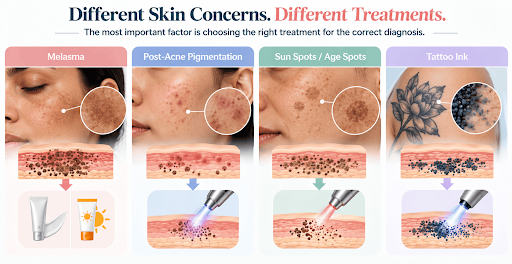 Understanding and Treating Facial Melasma and Hyperpigmentation with Cosmelan Peel