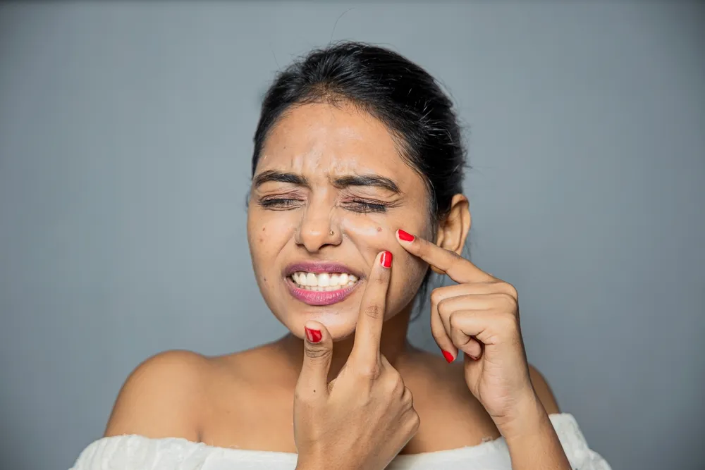 Acne Treatment in Gurgaon – DermaTales Clinic