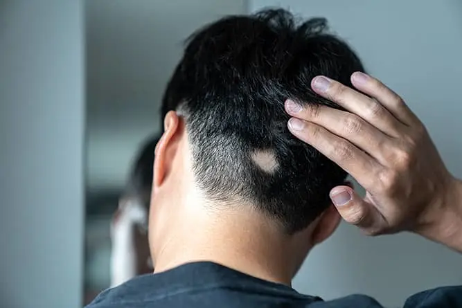 Alopecia Areata treatment in Gurgaon