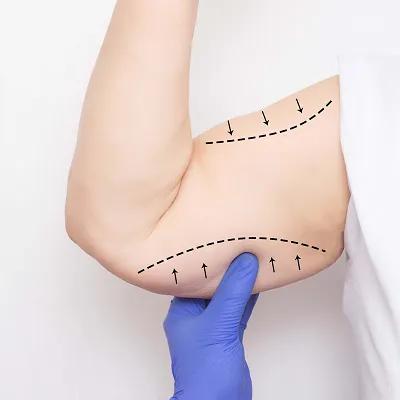 Arm Lift Surgery at DermaTales