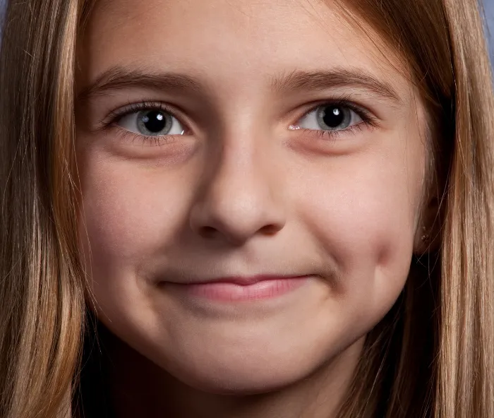 Dimple Creation at DermaTales