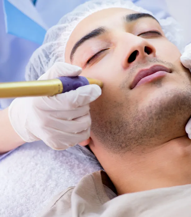 Advanced Acne Scar Treatment at DermaTales