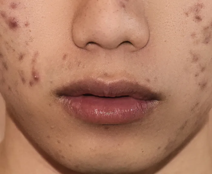 Laser For Chickenpox Scars