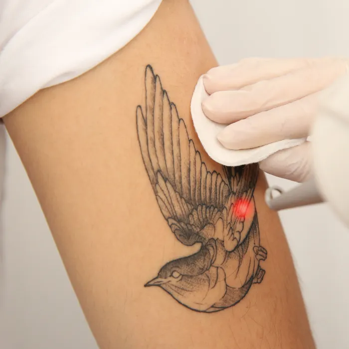 Laser Tattoo Removal