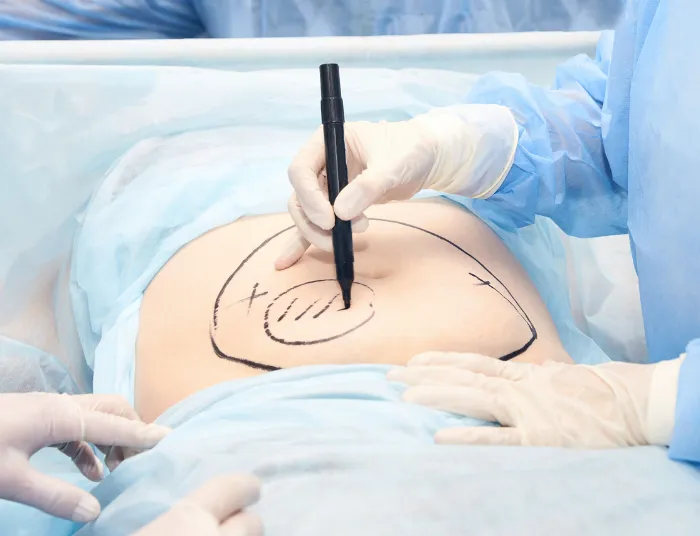 Liposuction Treatment at DermaTales