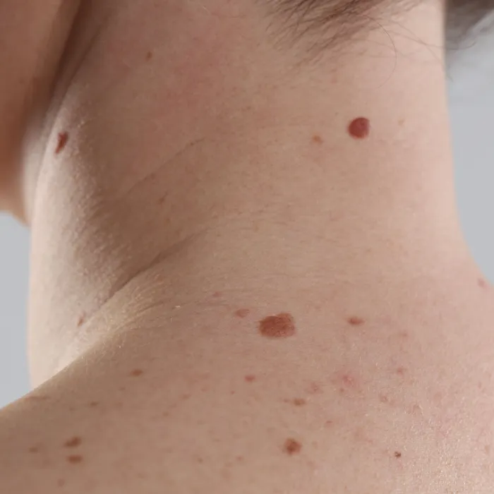 Neck Pigmentation Treatment