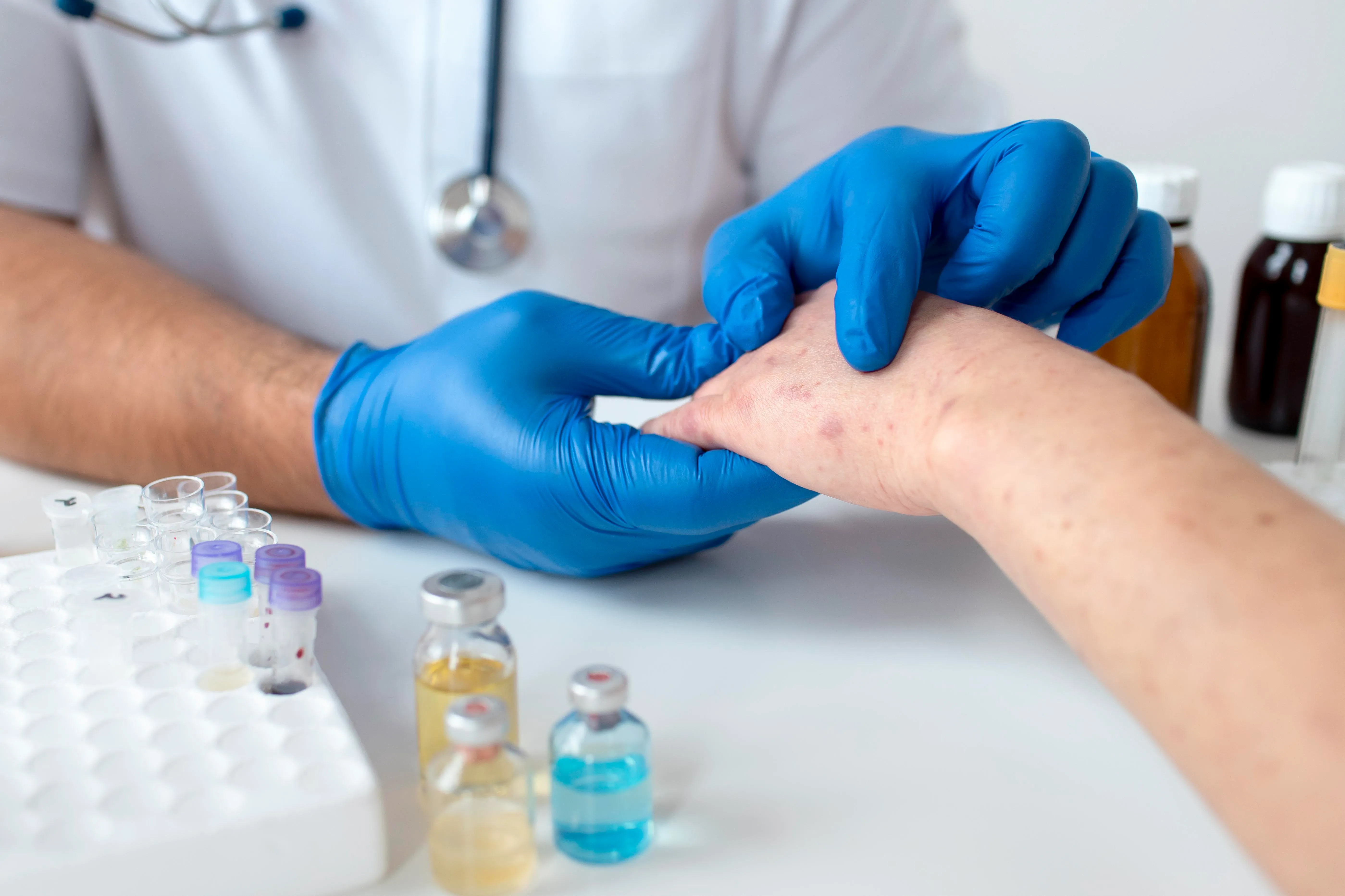skin Allergy treatment