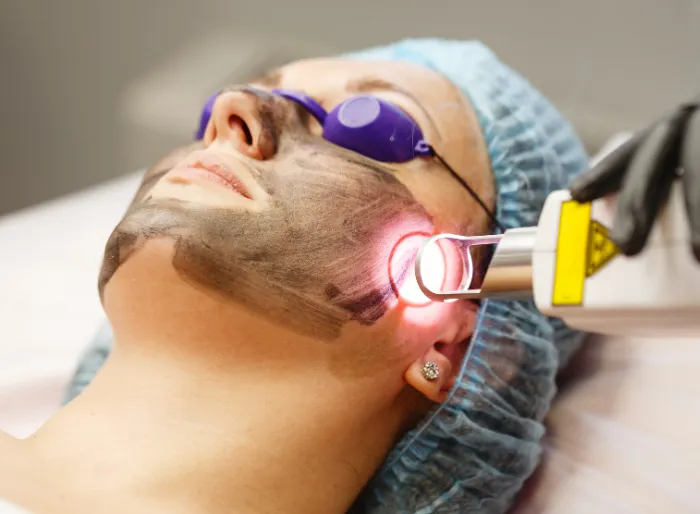 Skin Laser Treatment at DermaTales