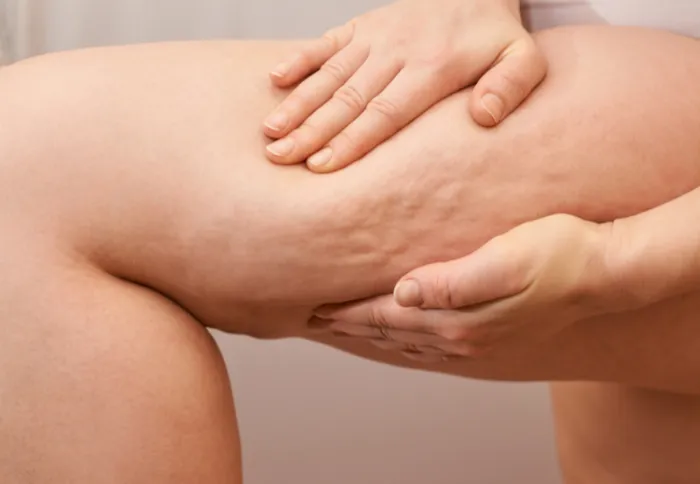 Thigh Lift Surgery at DermaTales