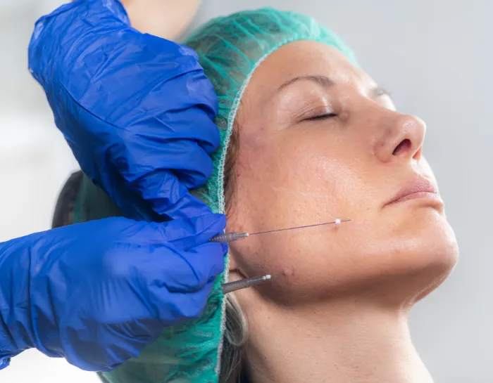 Thread Lift Treatment at DermaTales