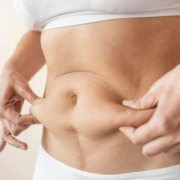 Tummy Tuck Surgery at DermaTales