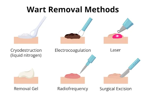 wart-removal-treatment